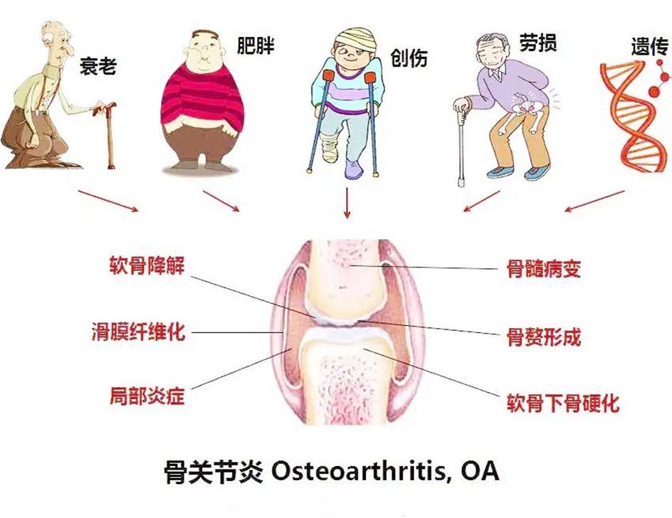 關(guān)節(jié)炎