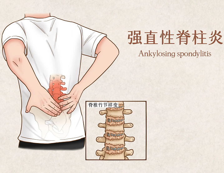 強(qiáng)直性脊柱炎