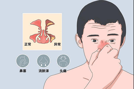 鼻炎癥狀